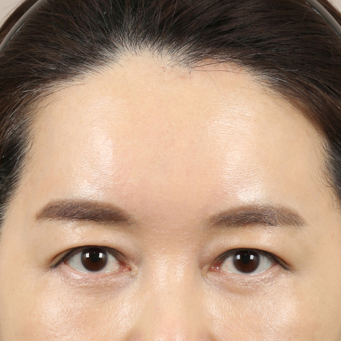 이마거상술 수술 후