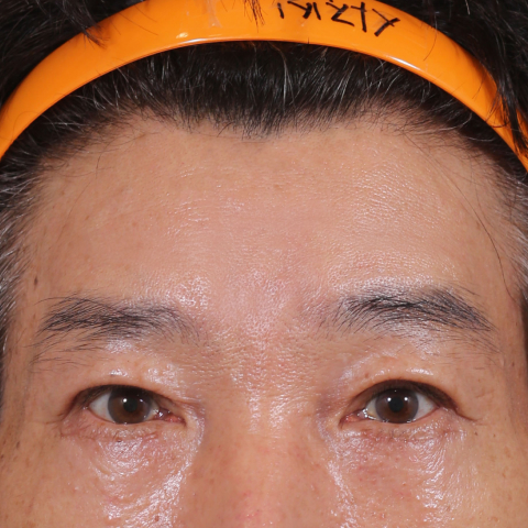이마거상술 수술 후
