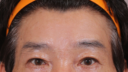 이마거상술 수술 후