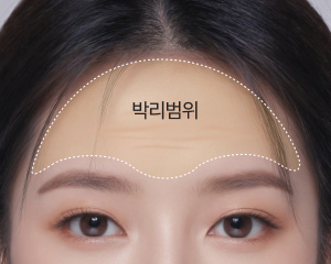 엔도타인 이마거상술 수술방법 2