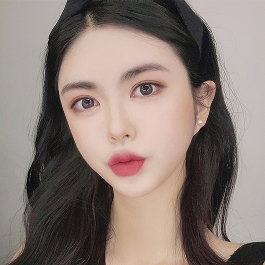 쌍꺼풀 수술 후 3개월