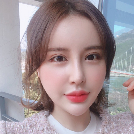 쌍꺼풀 수술 후 3개월