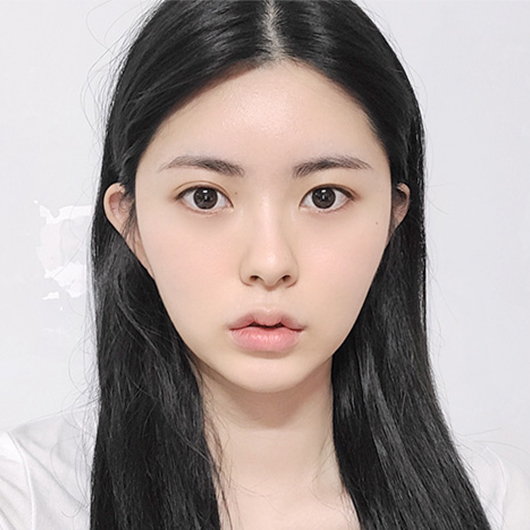 쌍꺼풀 수술 전