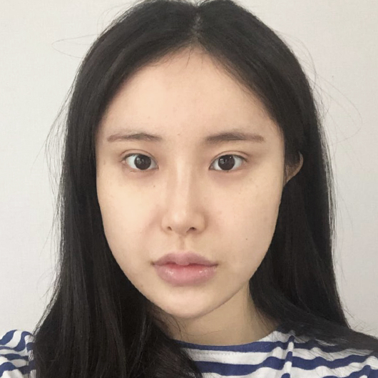 쌍꺼풀 수술 전