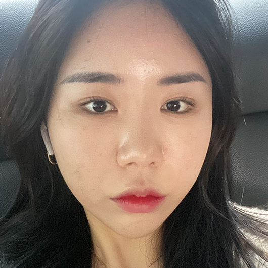 쌍꺼풀 수술 전
