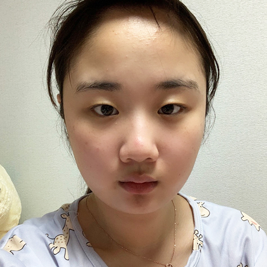 쌍꺼풀 수술 전