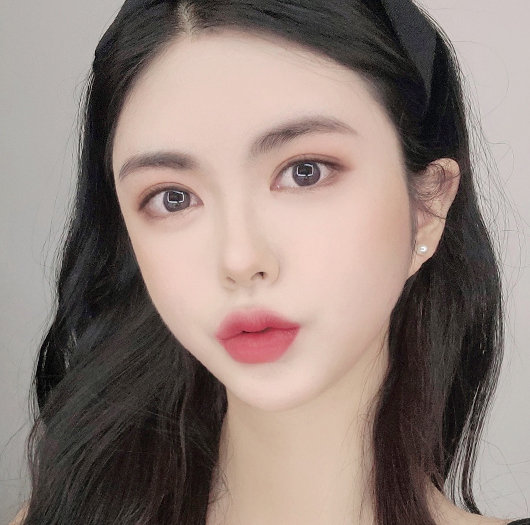 트임성형 수술 후