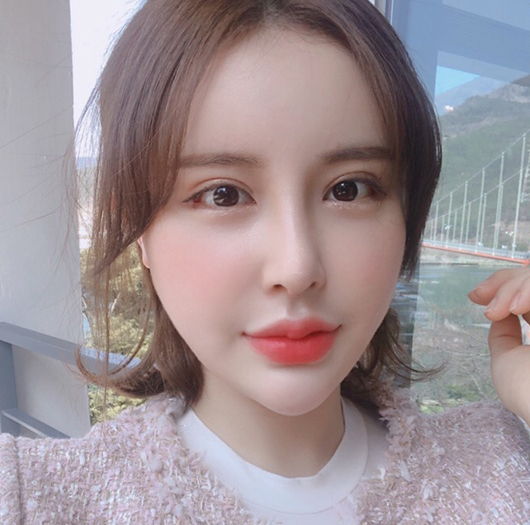 트임성형 수술 후
