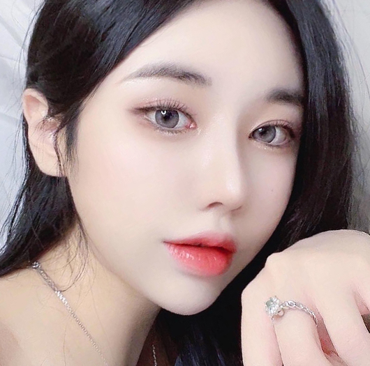 트임성형 수술 후