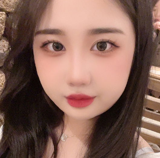 트임성형 수술 후