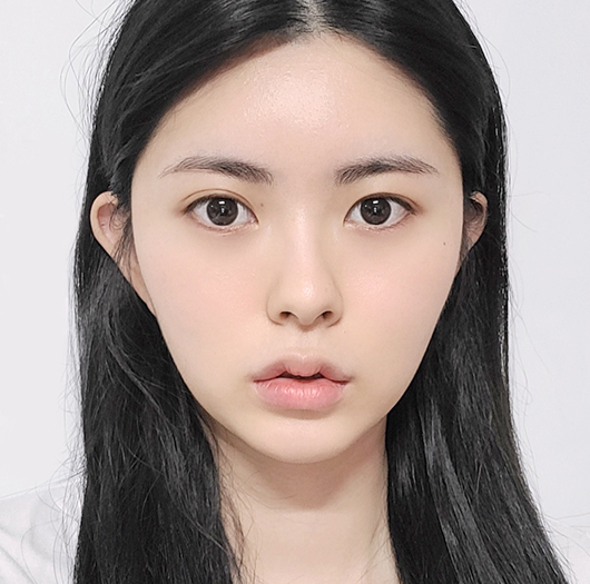트임성형 수술 전