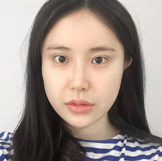 트임성형 수술 전