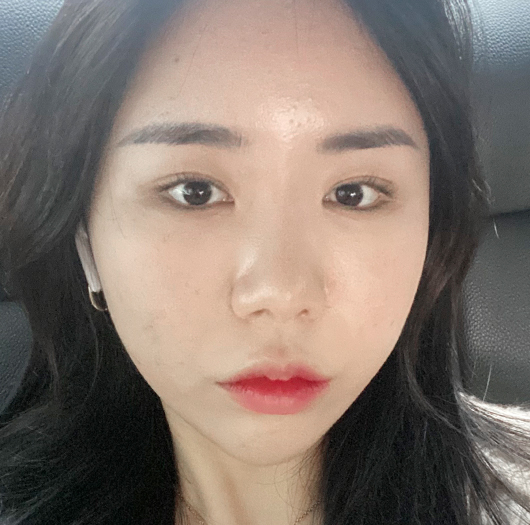 트임성형 수술 전