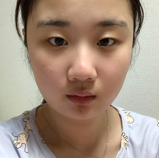트임성형 수술 전
