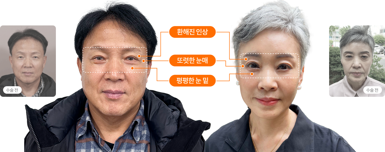 눈꺼풀 처짐? 눈 밑 처짐? 중년 눈성형 개인 솔루션이 필요합니다.