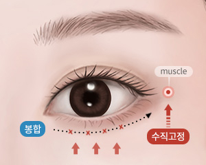 중년 하안검 수술방법