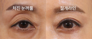 눈썹하거상술 전 후 사진
