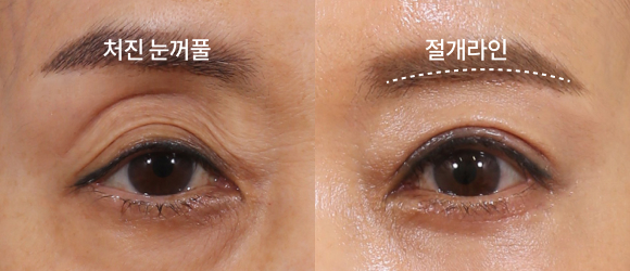 눈썹하거상술 전 후 사진