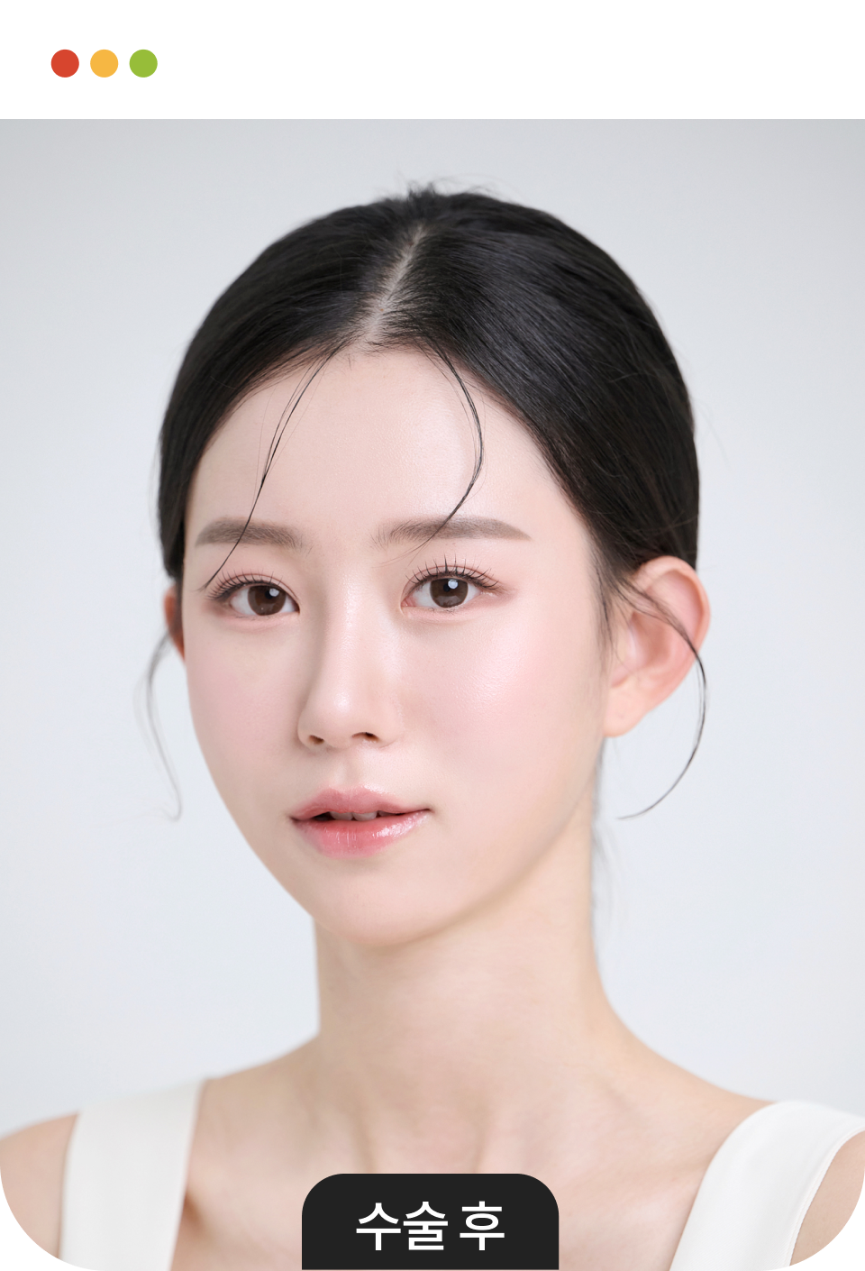 사각턱성형 수술정보 이미지