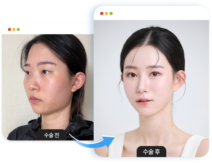 사각턱성형 수술정보 이미지