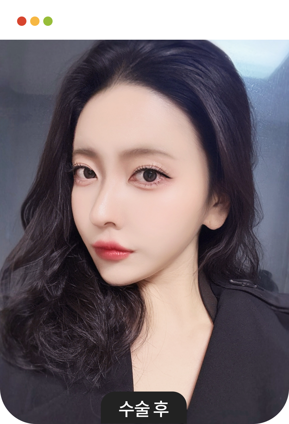 앞턱성형 수술 전