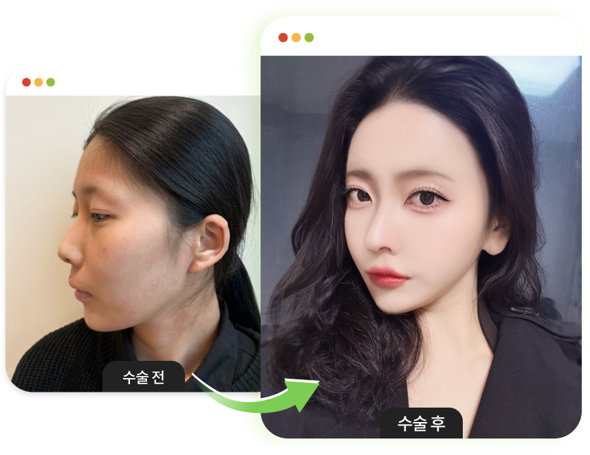 앞턱성형 수술 전