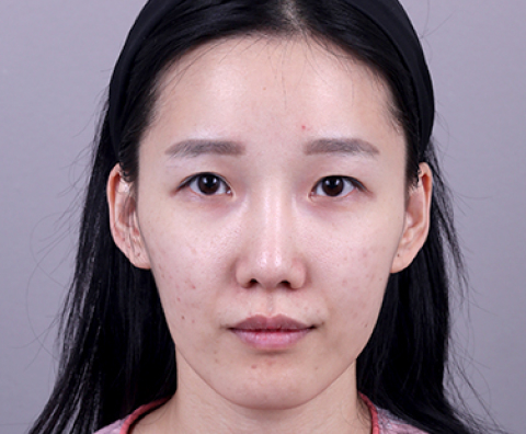 사각턱성형 수술 전