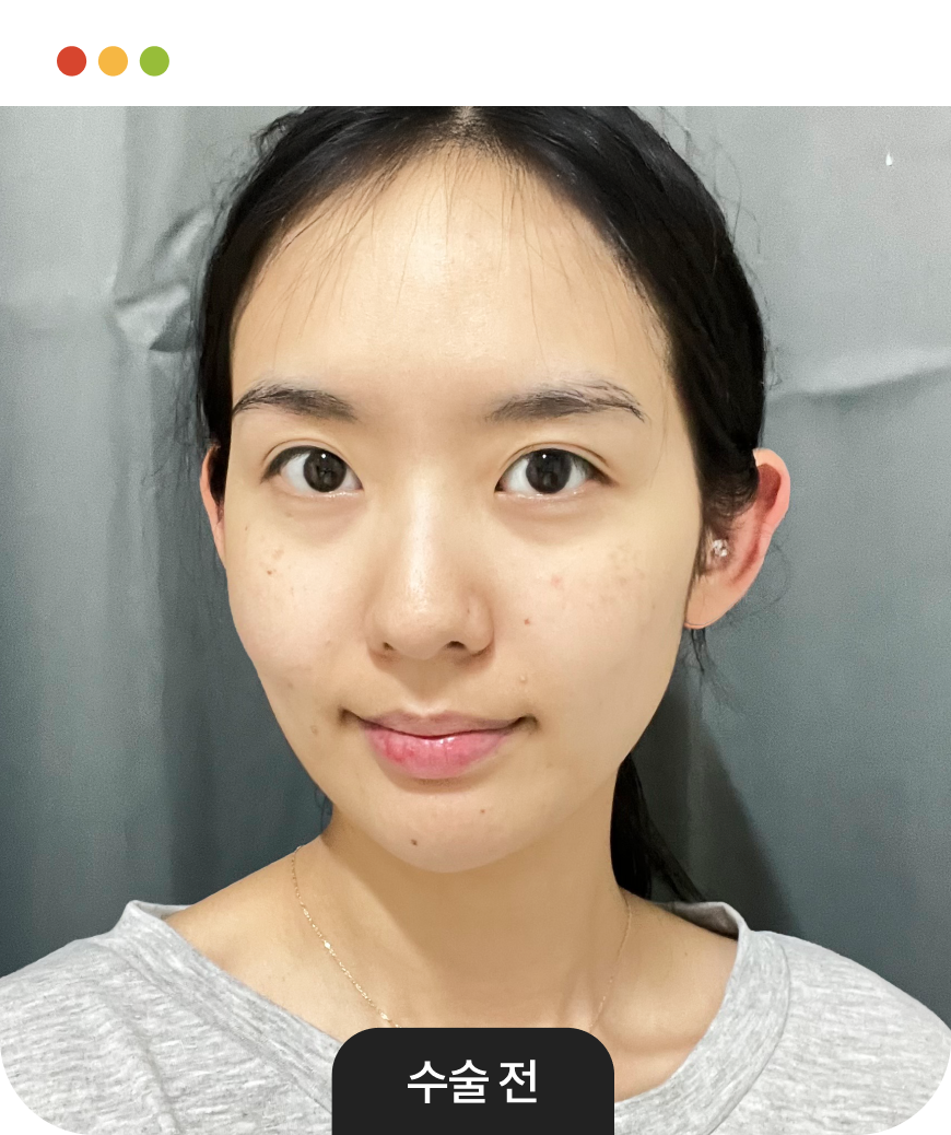 광대축소 전후사진 말풍선
