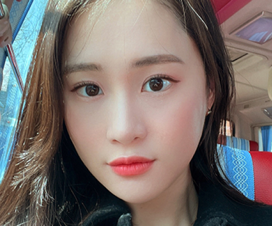 사각턱성형 수술 후
