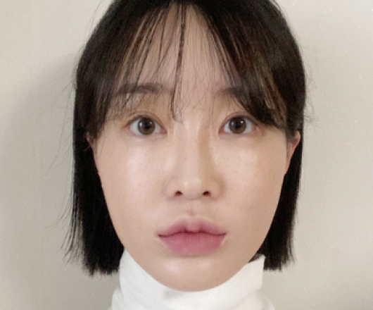 사각턱성형 수술 전
