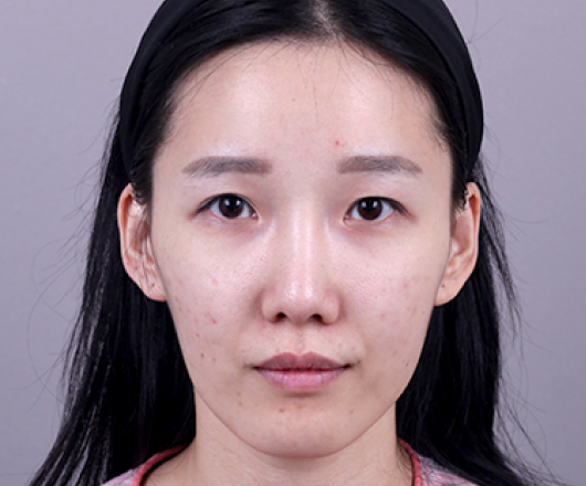 사각턱성형 수술 전