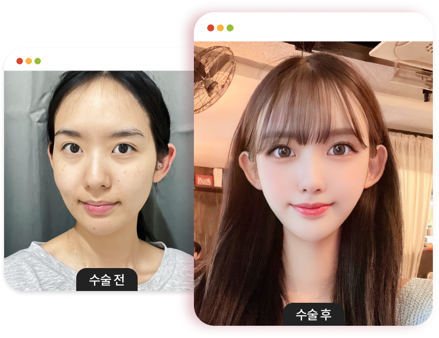 광대축소 전후사진