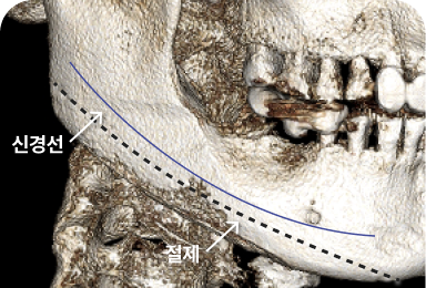 광대 비고정법 수술 정보 이미지