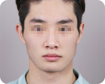 수술 전 이미지