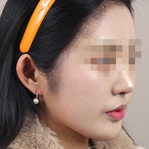 얼굴지방이식 수술 후 이미지