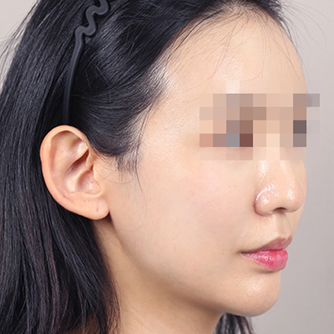 얼굴지방이식 수술 후 이미지