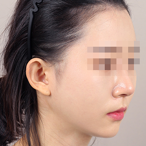 얼굴지방이식 수술 후 이미지