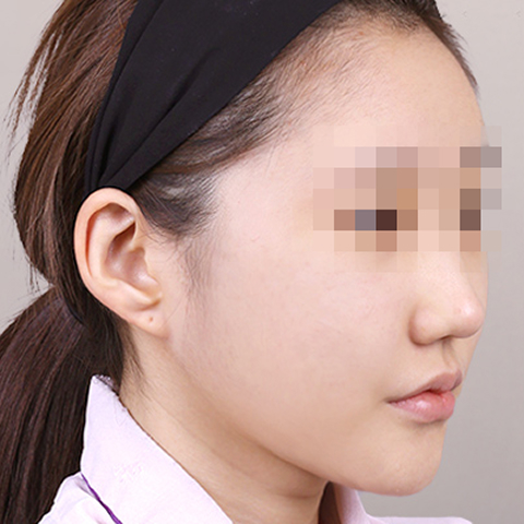 얼굴지방이식 수술 후 이미지