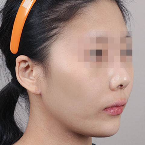 얼굴지방이식 수술 전 이미지