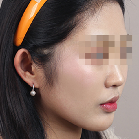 얼굴지방이식 수술 전 이미지