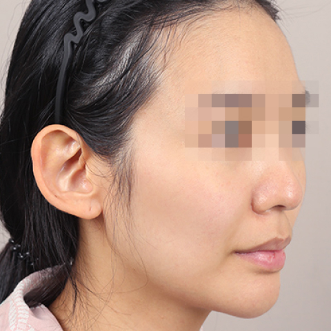 얼굴지방이식 수술 전 이미지