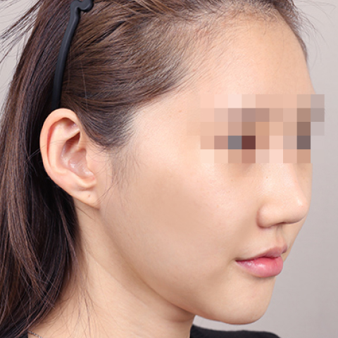 얼굴지방이식 수술 전 이미지