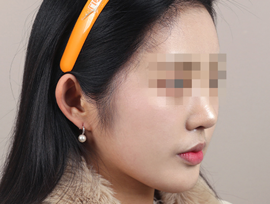 얼굴지방이식 수술 후 이미지
