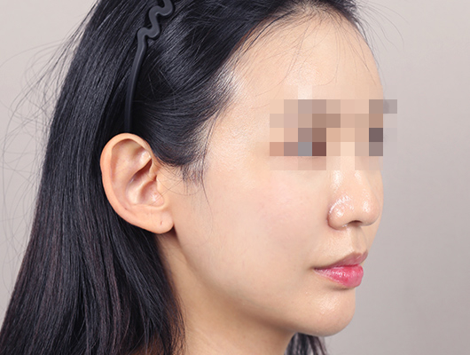 얼굴지방이식 수술 후 이미지
