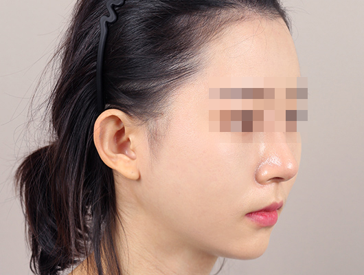 얼굴지방이식 수술 후 이미지