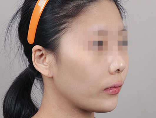 얼굴지방이식 수술 전 이미지