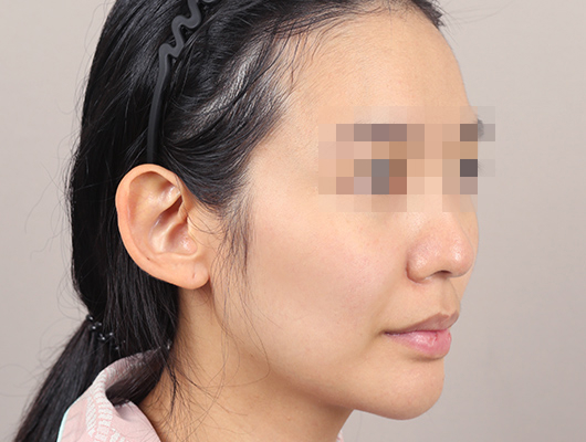 얼굴지방이식 수술 전 이미지