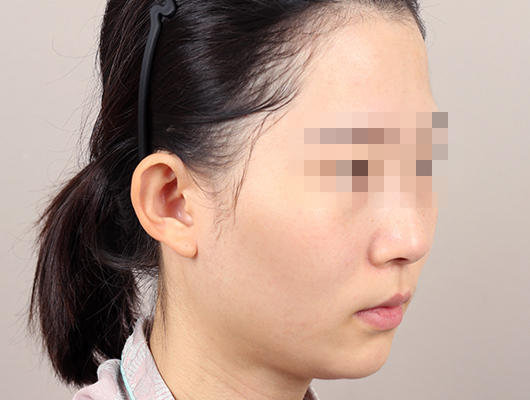 얼굴지방이식 수술 전 이미지
