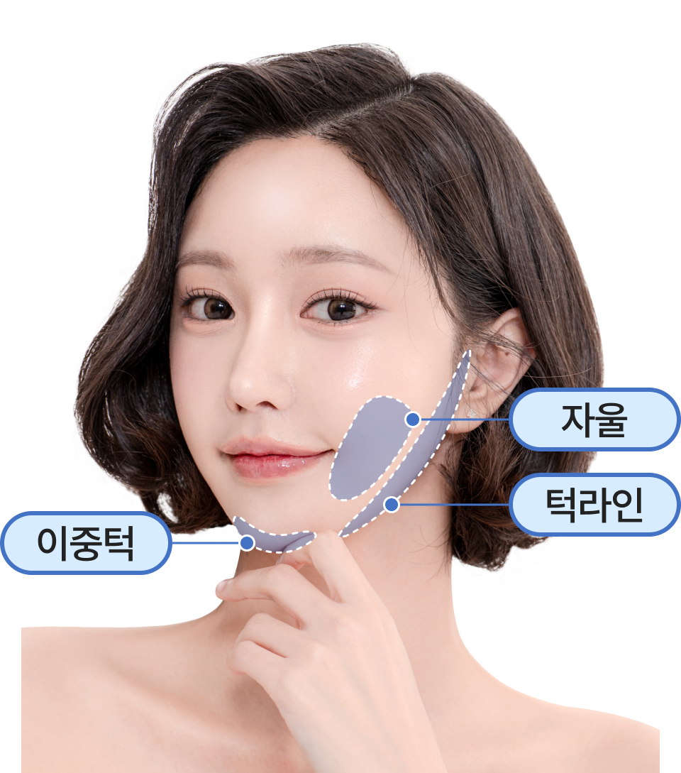 토탈V윤곽술 시술 부위 이미지
