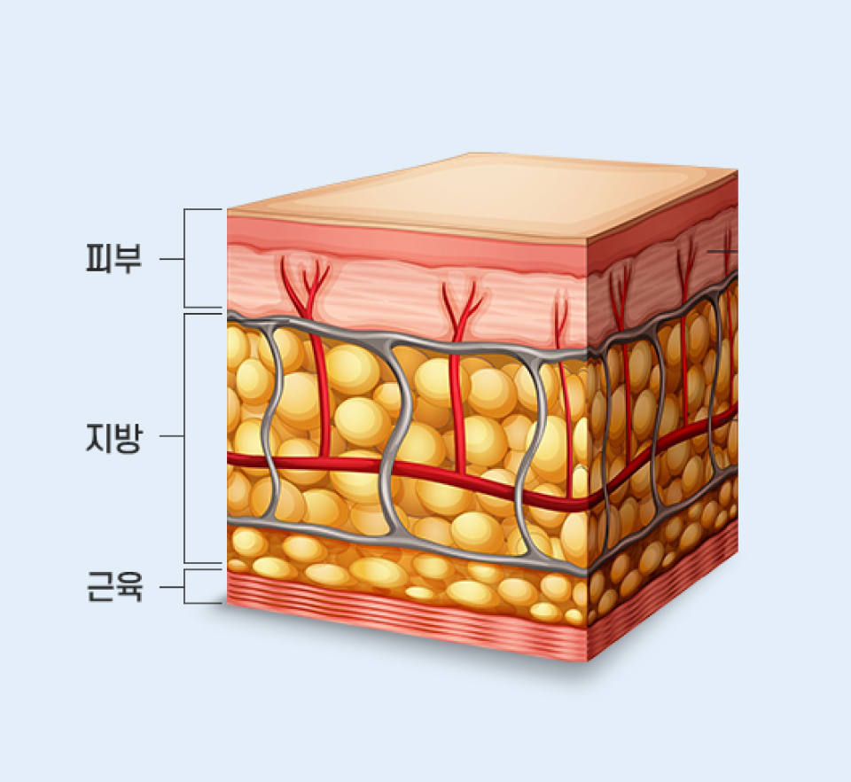 토탈V윤곽술 모델 이미지
